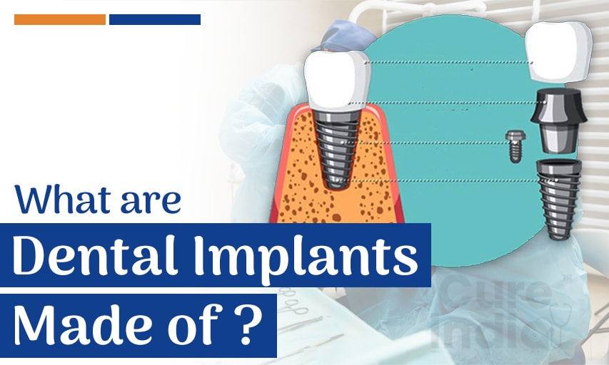 What are Dental Implants Made of?